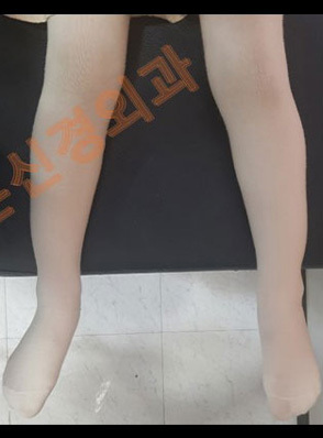 안짱다리(안짱걸음) 교정 전·후	