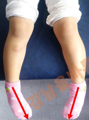 안짱다리(안짱걸음) 교정 전·후