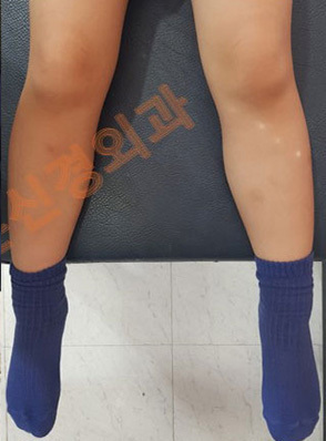 안짱다리(안짱걸음) 교정 전·후	