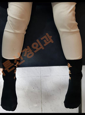 안짱다리(안짱걸음) 교정 전·후	