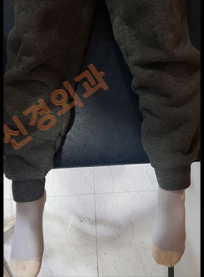 안짱다리(안짱걸음) 교정 전·후	
