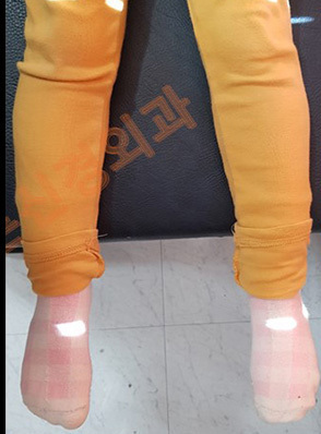 안짱다리(안짱걸음) 교정 전·후